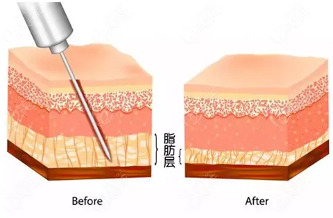 抽脂手術(shù)對身體有什么傷害？該不該禁止抽脂手術(shù)？